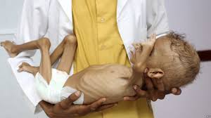 انتشار وباء الكوليرا مجدداً في اليمن