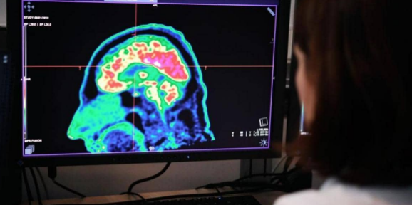 لا تستهن بإصابات الدماغ "الخفيفة".. دراسة تكشف حقائق صادمة