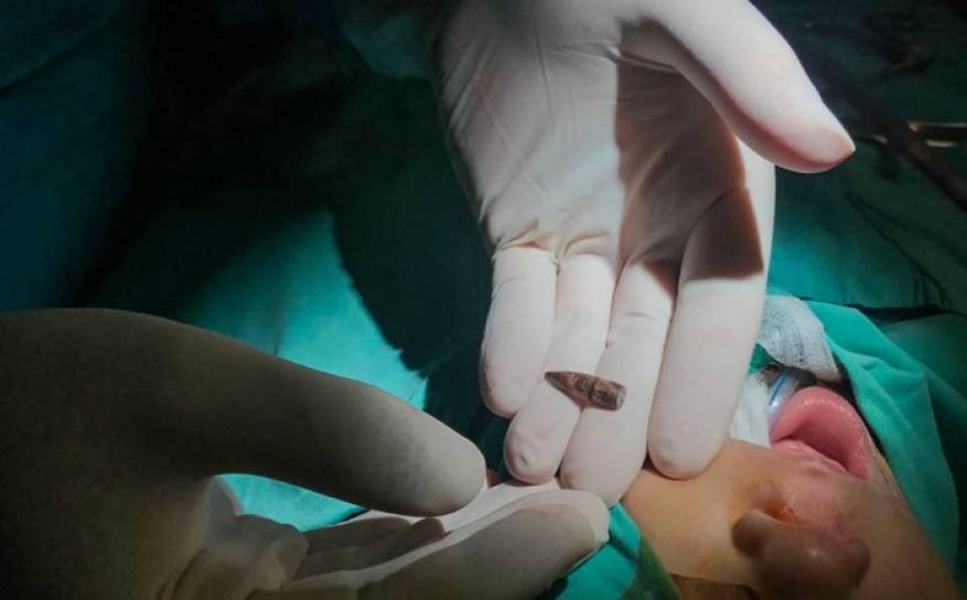 بمشاركة طبيب فلسطيني.. فريق طبي أمريكي يستخرج رصاصة (إسرائيلية) من رأس رضيعة في نابلس
