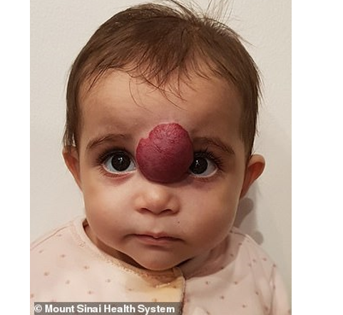 جراحة حساسة "تغير حياة" طفلة كويتية وُلدت بورم في وجهها