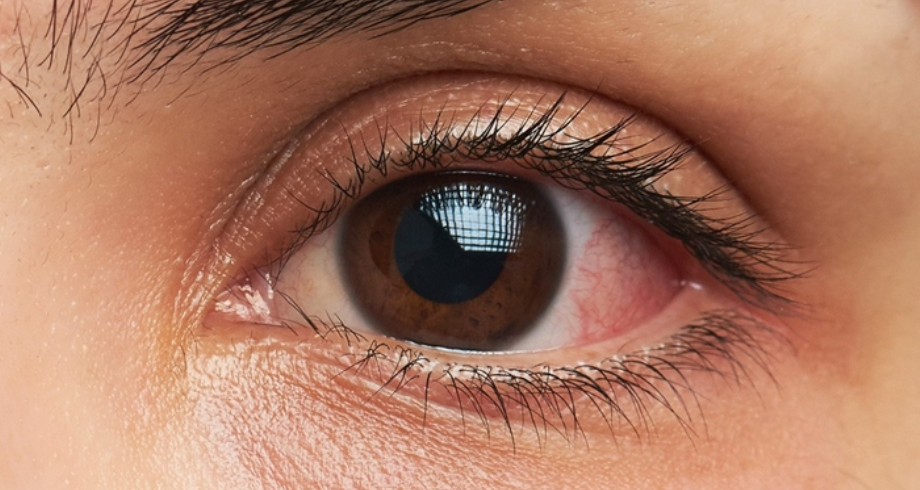 نتائج مشجعة لعلاج جديد لأكثر أشكال سرطان العين شيوعا