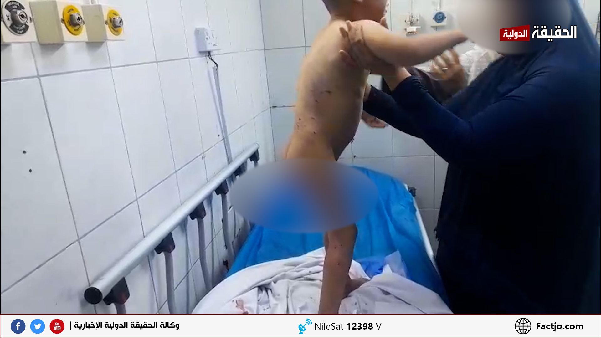 كلاب ضالة تنهش طفلًا بالمفرق... والجهات المعنية غائبة.. صور