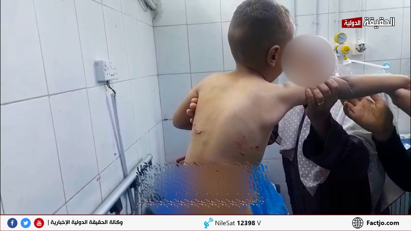 كلاب ضالة تنهش طفلًا بالمفرق... والجهات المعنية غائبة.. صور