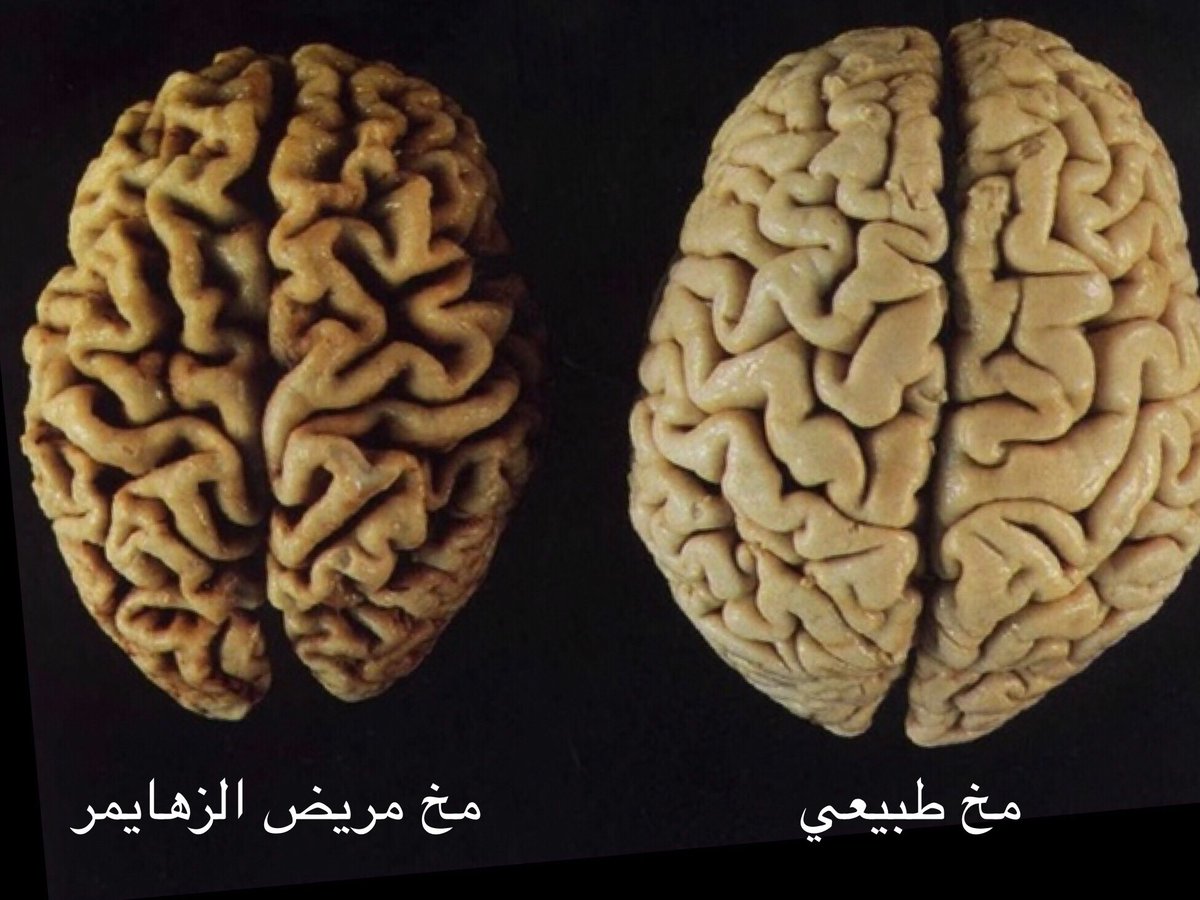 سابقة علمية.. استخدام دماغ بشري حي لرصد الزهايمر قبل ظهوره